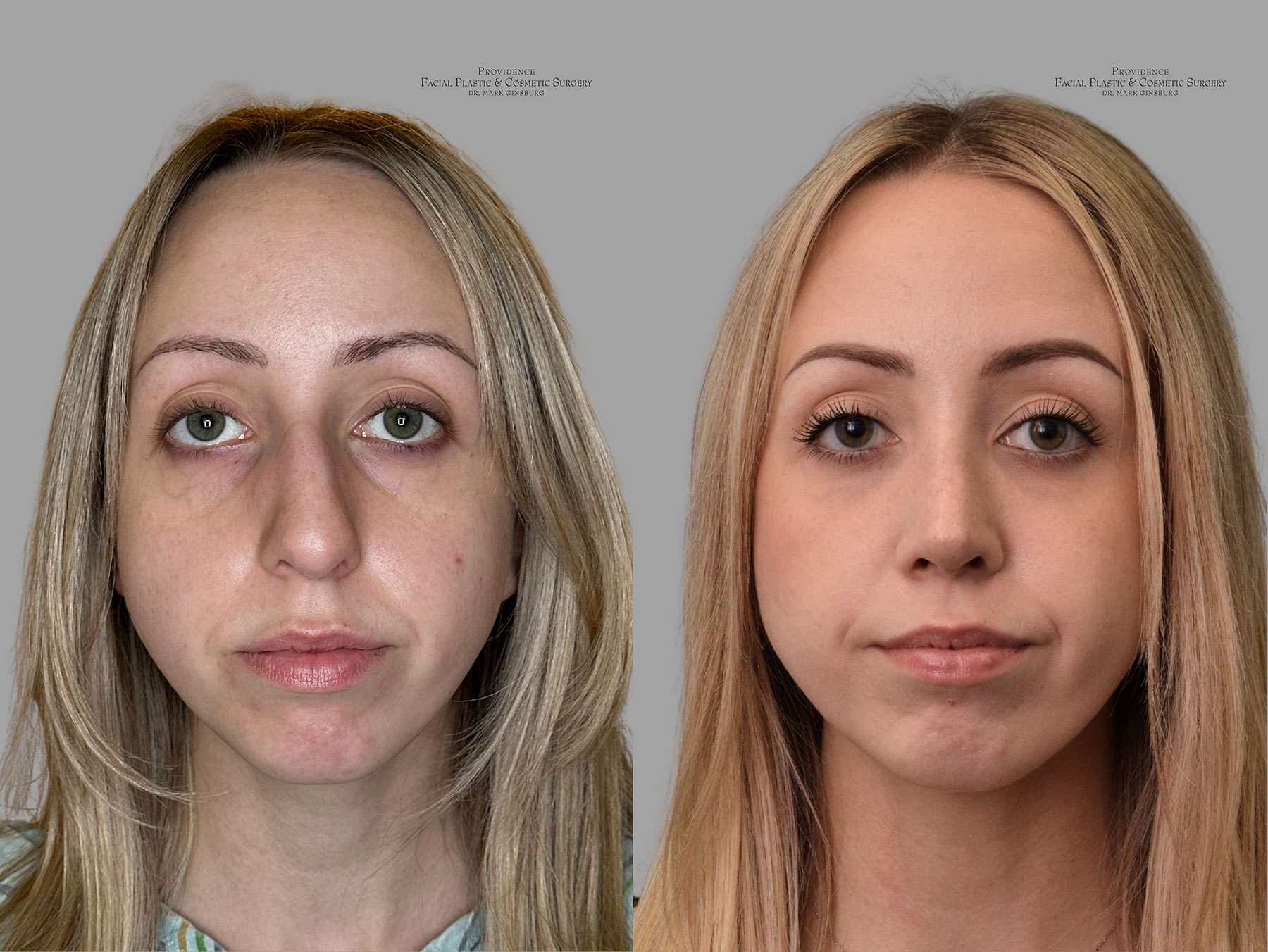 Philadelphia woman after receiving a facelift in Philadelphia, PA