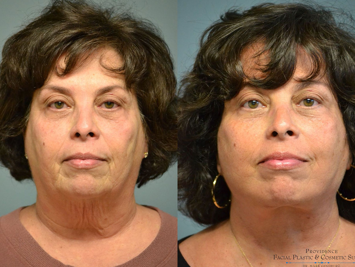 Facial Plastic Surgery