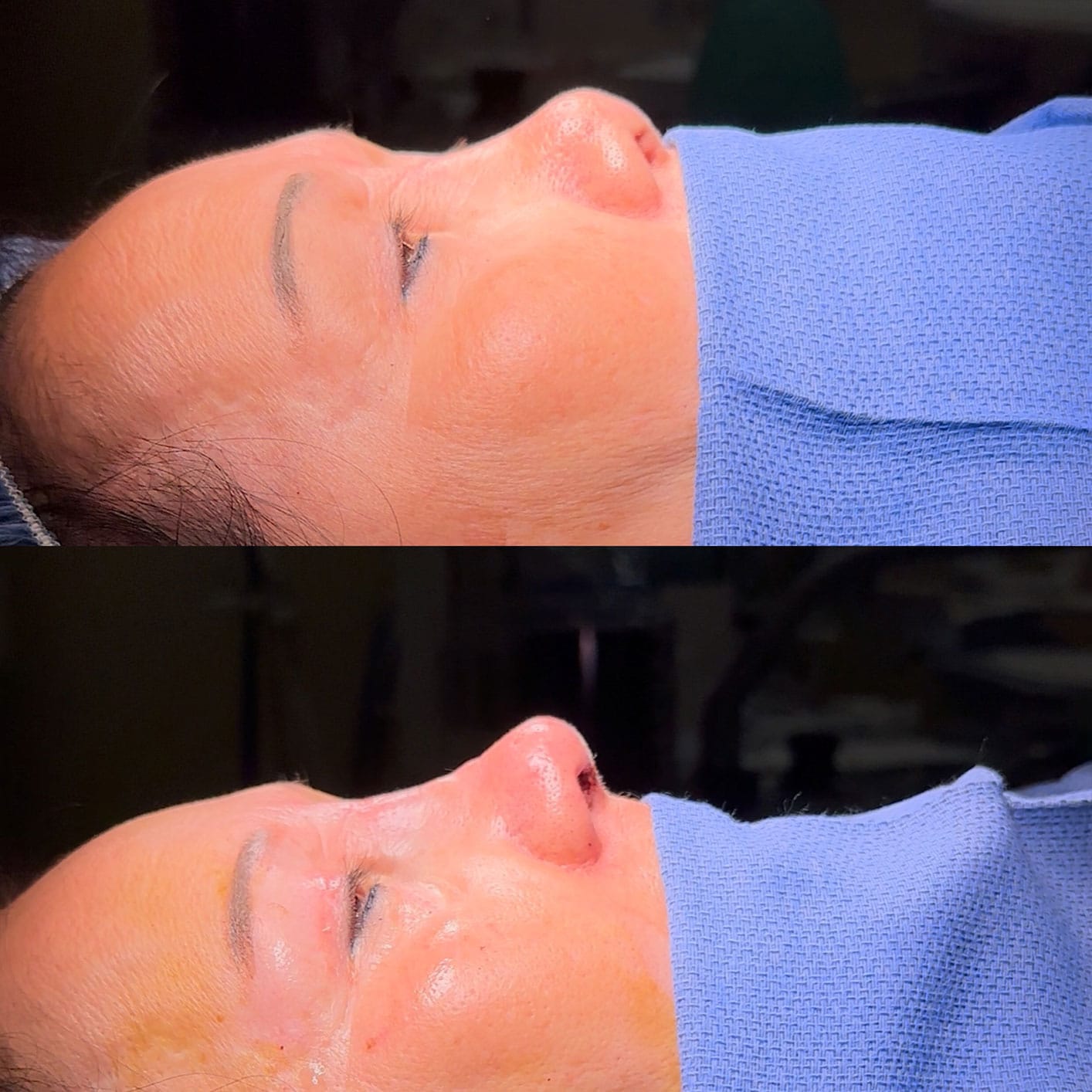 Woman who received a revision rhinoplasty in Philadelphia, PA.