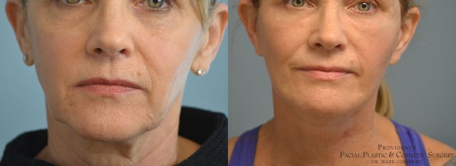 Before and after results of a mini facelift in Philadelphia.